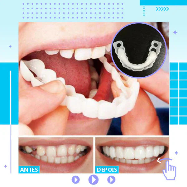 Snap On Smile – Lentille dentaire